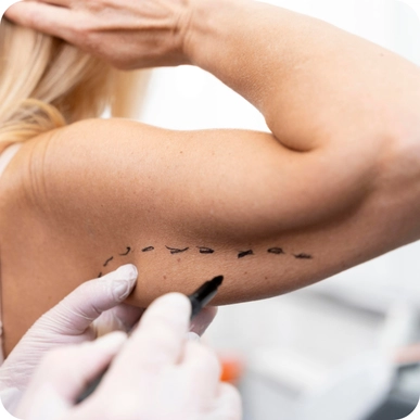 Arm Lift-Brachioplasty