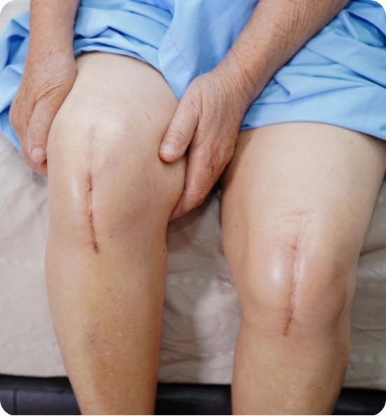 Best Countries for Knee Replacement Surgery Advanced Care & Cost Savings