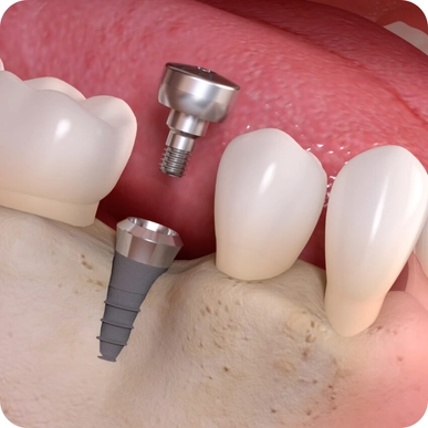 Bone Grafting & Sinus Lift for Implants