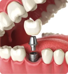 Bone Grafting and Sinus Lift for Implants Surgery Abroad Rebuild Your Smile with Confidence