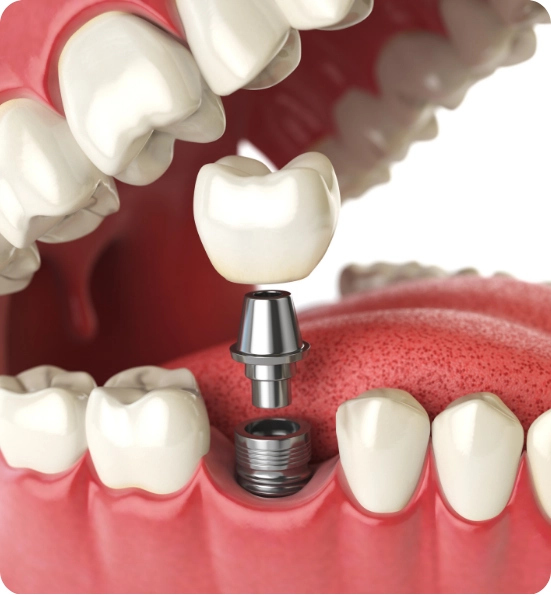 Bone Grafting and Sinus Lift for Implants Surgery Abroad Rebuild Your Smile with Confidence