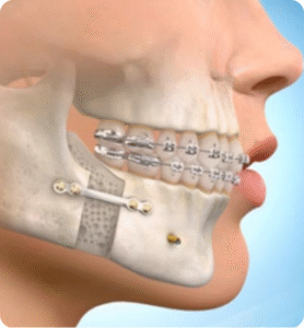 Corrective Jaw Surgery for Implants Surgery Abroad Rebuild Your Smile with Confidence