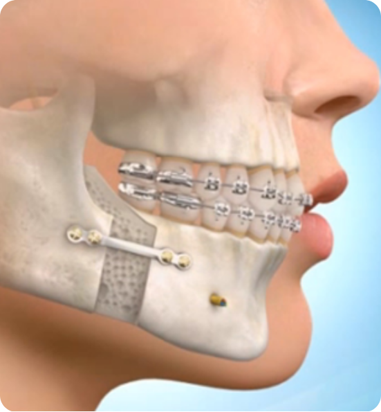 Corrective Jaw Surgery for Implants Surgery Abroad Rebuild Your Smile with Confidence