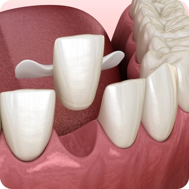 Dental Bonding