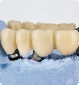 Dental Crowns and Bridges Abroad Rebuild Your Smile with Confidence