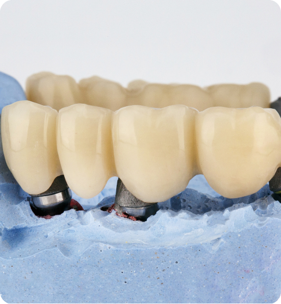 Dental Crowns and Bridges Abroad Rebuild Your Smile with Confidence