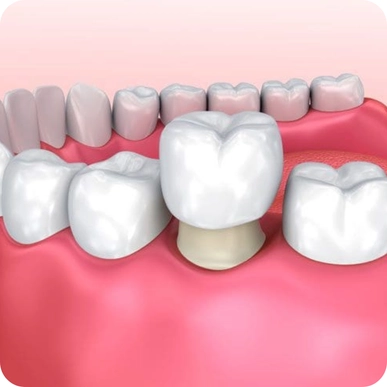 Dental Crowns and Bridges