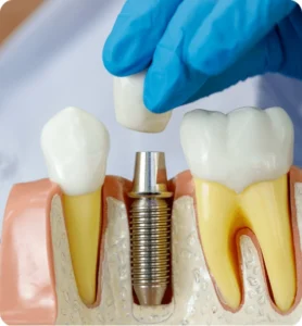 Dental Implants