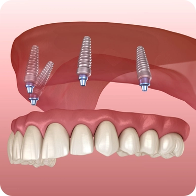 Dentures and Implants