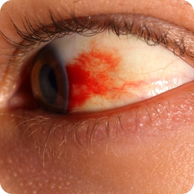 Diabetic Retinopathy