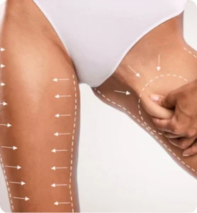 Explore the Best Countries for Thigh Lift Surgery Abroad Achieve Toned, Sculpted Legs with Thighplasty