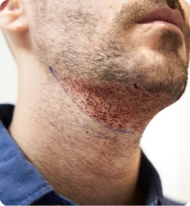 Eyebrow & Beard Transplants