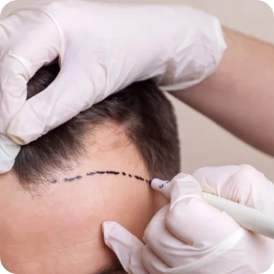 FUT (Follicular Unit Transplantation)