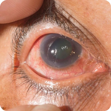 Glaucoma Treatment