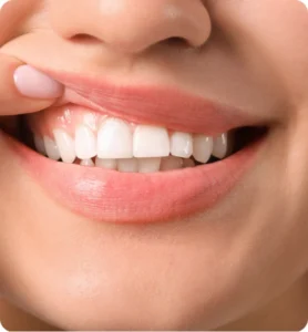 Gum Contouring and Reshaping Abroad Rebuild Your Smile with Confidence