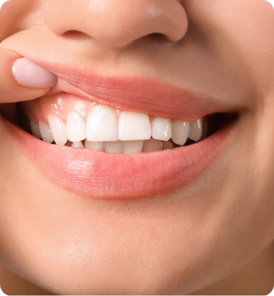 Gum Contouring and Reshaping Abroad Rebuild Your Smile with Confidence