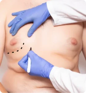 Gynecomastia Surgery Abroad Regain Confidence with Male Breast Reduction