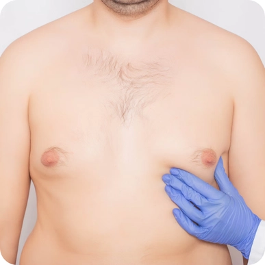 Gynecomastia Surgery (Male Breast Reduction)