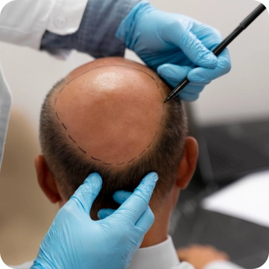 Hair Transplant Services