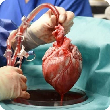 Heart Transplant