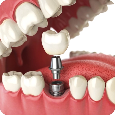 Implant-Supported Dentures