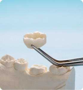 Inlays and Onlays Abroad Rebuild Your Smile with Confidence