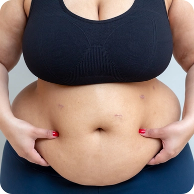 Liposuction (Fat Removal)