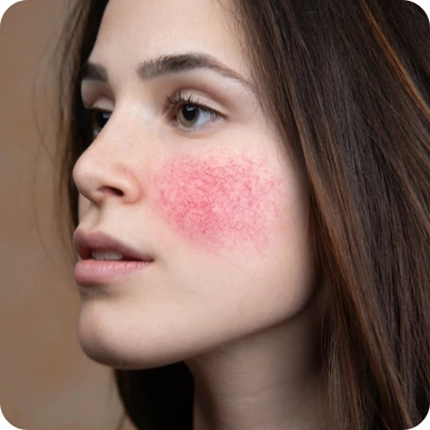 Lupus Stem Cell Treatment