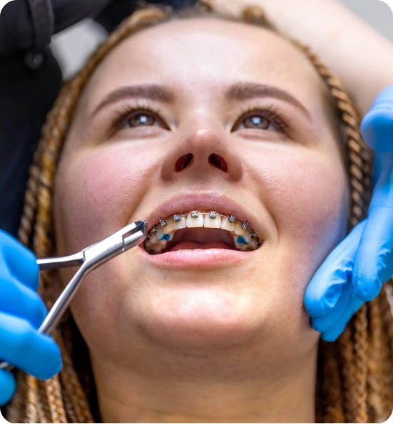 Metal and Ceramic Braces Abroad Rebuild Your Smile with Confidence