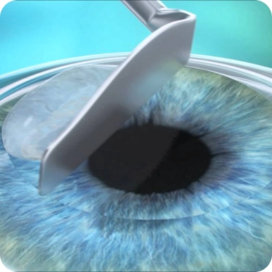 PRK Surgery