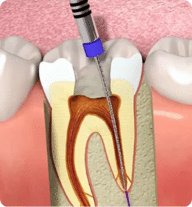 Root Canals Abroad Rebuild Your Smile with Confidence