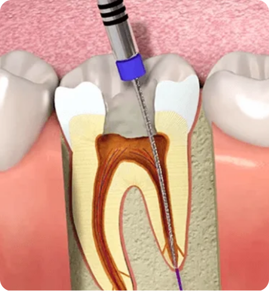 Root Canals Abroad Rebuild Your Smile with Confidence
