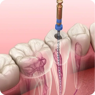 Root Canals