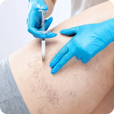 Sclerotherapy