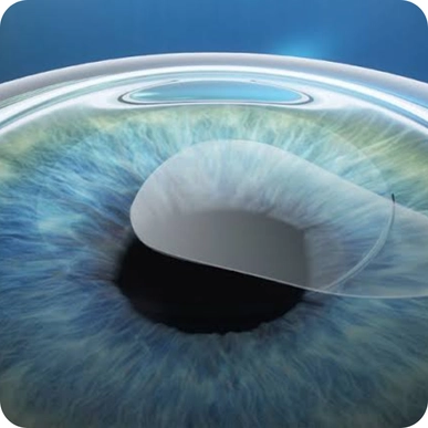 Smile Eye Surgery