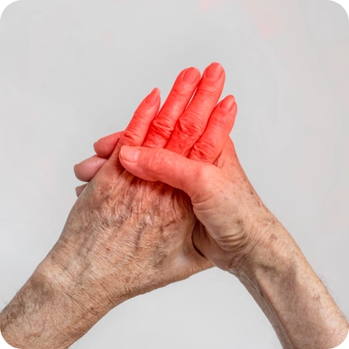 Stem Cell Therapy for Rheumatoid Arthritis