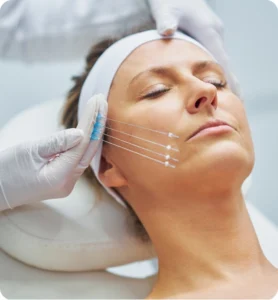 Thread Lift Abroad Non-Surgical Skin Rejuvenation with Natural Results