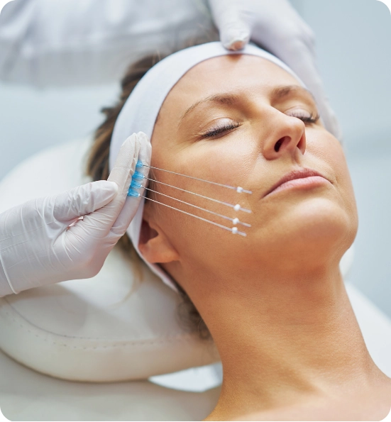 Thread Lift Abroad Non-Surgical Skin Rejuvenation with Natural Results