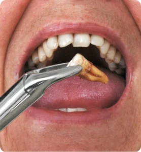 Tooth Extractions Surgery Abroad Rebuild Your Smile with Confidence