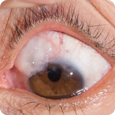 Trabeculectomy