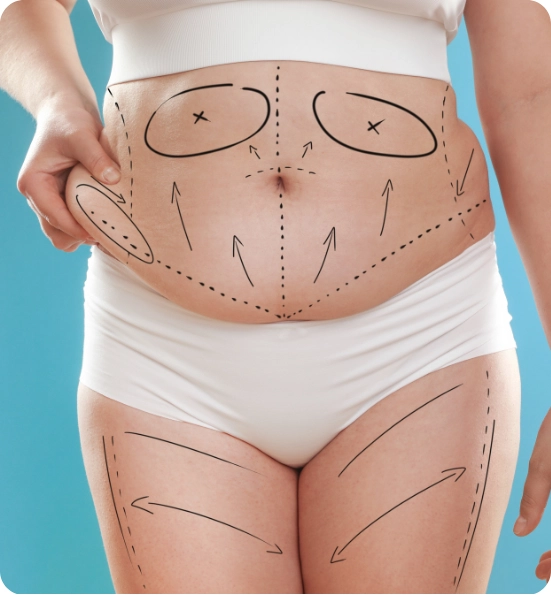 Tummy Tuck Surgery Abroad Reshape Your Confidence with Abdominoplasty